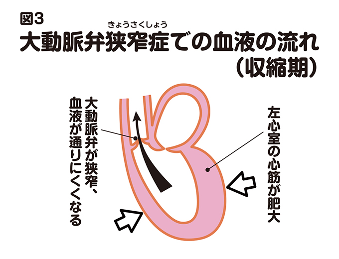 医師は大動脈弁狭窄症の雑音をどのように診断しますか?
