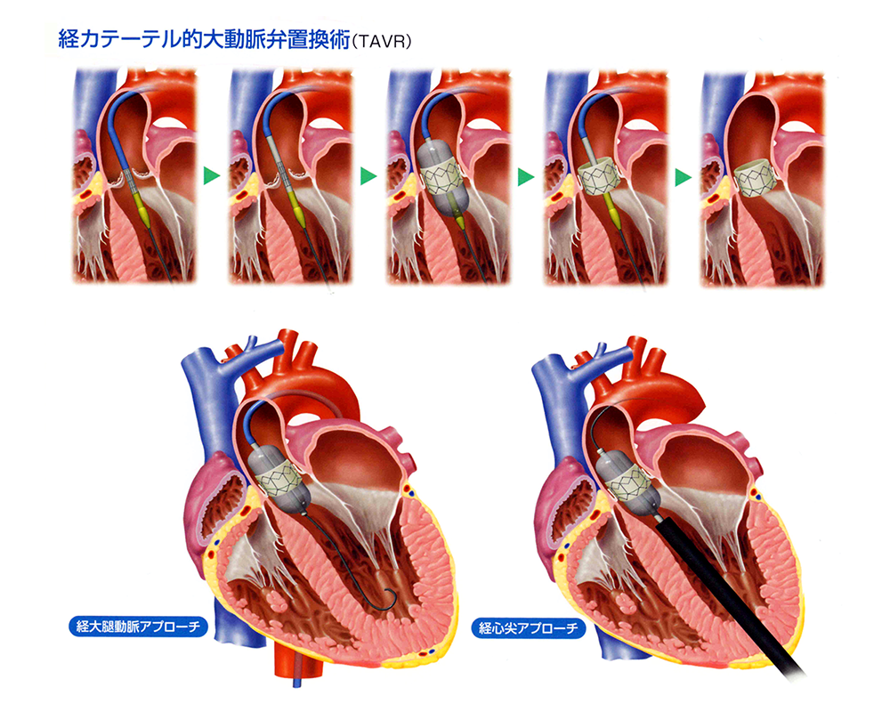 大動脈弁狭窄症は血圧にどのような影響を及ぼしますか?