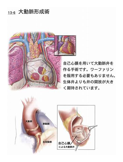 自己心膜を使った大動脈弁形成術