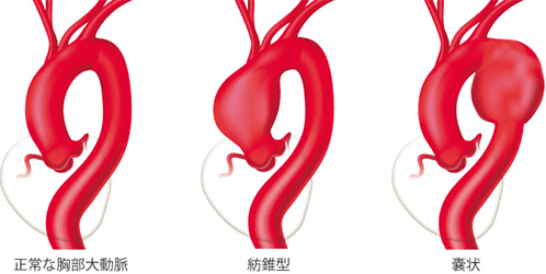 大動脈の血管壁