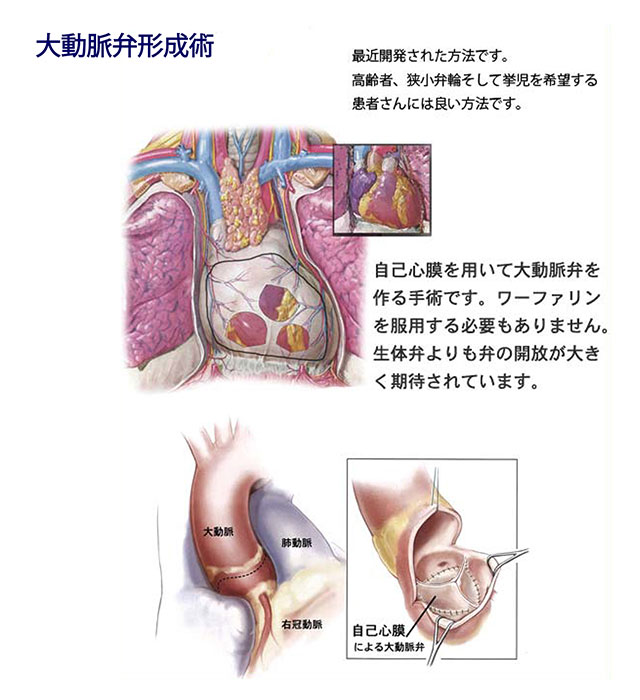 大動脈弁形成術